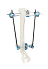 Gather Hoffmann 2 External Fixation Rods For Pelvic Fractures